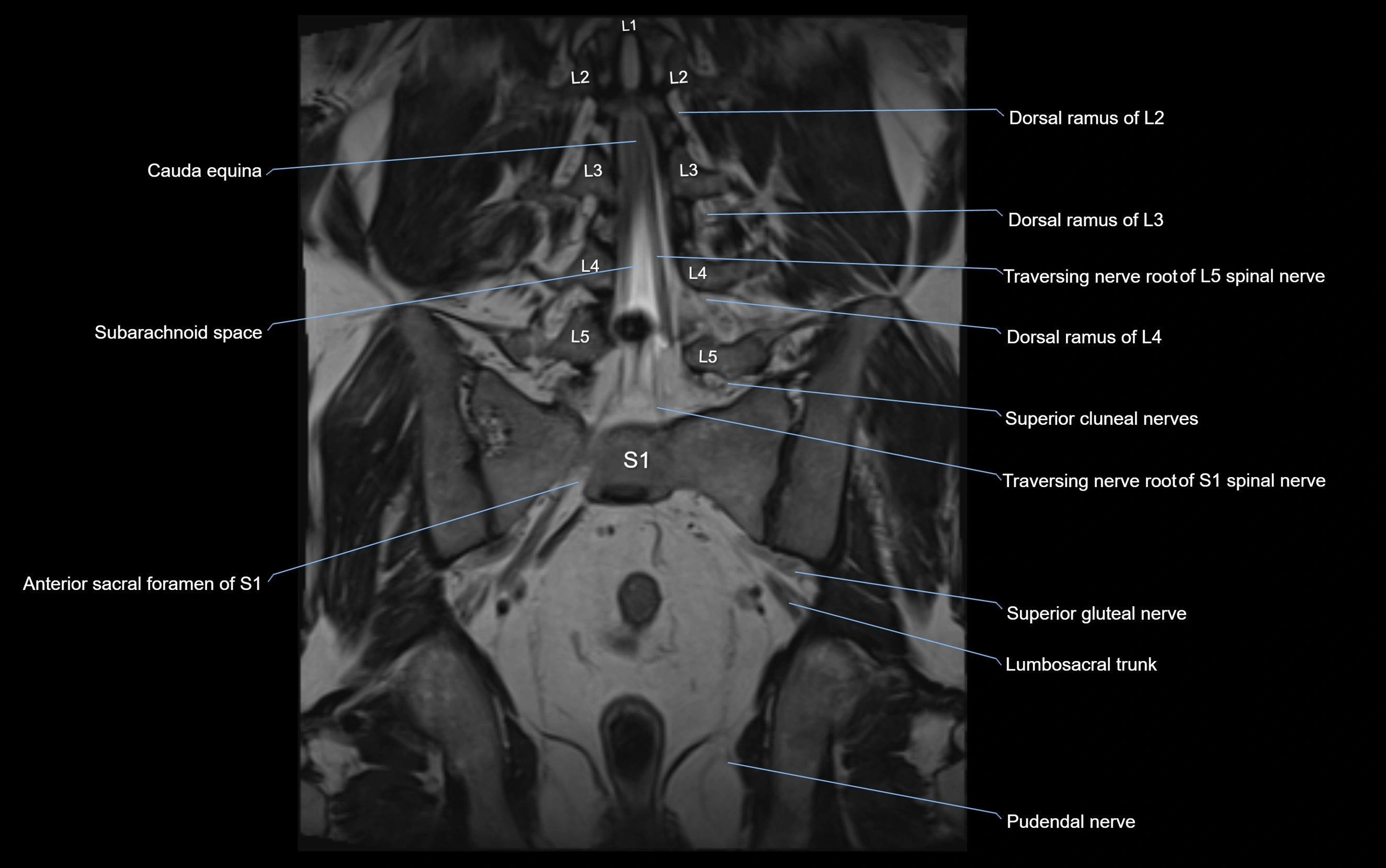 MR lumbosacral plexus cross sectional anatomy 3T  radiology  image-img-09001-00044.webp